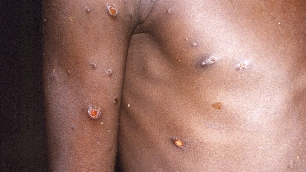 Variola maimuței prezintă un risc moderat pentru sănătatea publică, potrivit OMS