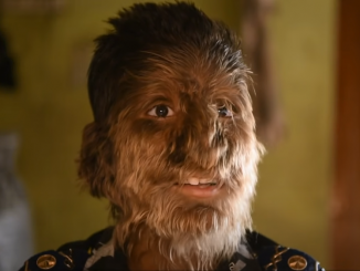 Băiatul cu sindromul vârcolacului: „Copiii sunt speriați de mine și se tem că îi voi mușca”