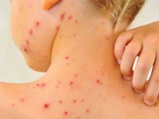 OMS și CDC anunță că rujeola reprezintă acum o amenințare globală iminentă din cauza unei pandemii