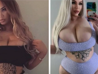 Caz extrem de rar: Pieptul unei femei nu se oprește din creștere. „Bărbații mă privesc urât și hainele nu-mi vin niciodată”